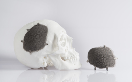 Impression 3D implant crânien personnalisé 