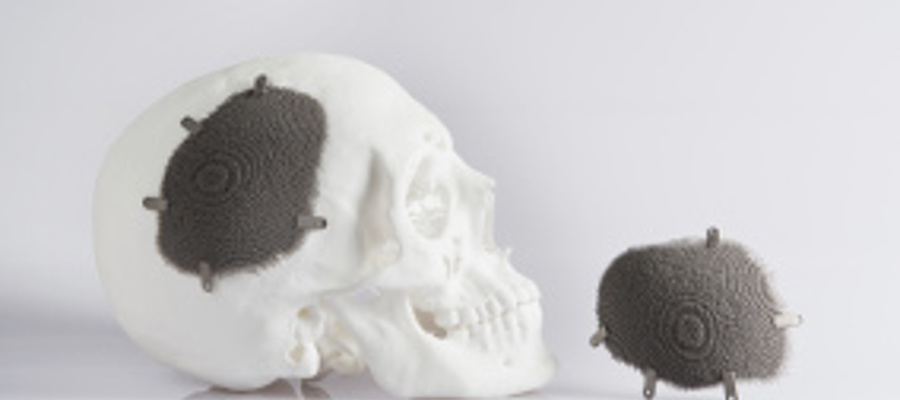 Novax DMA cranial implant built by Protolabs